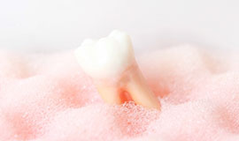 親知らずの移植による自然歯での補綴も